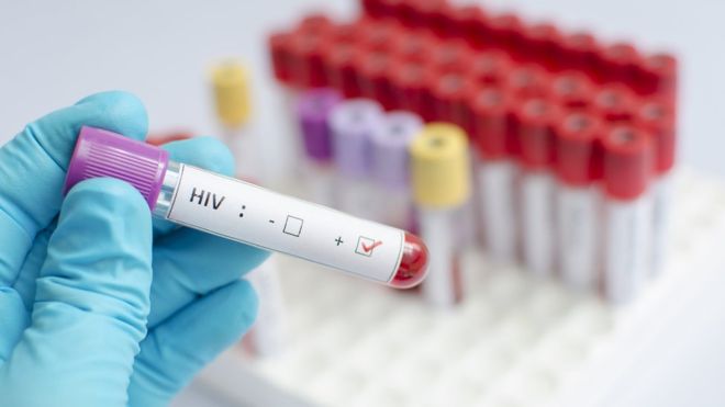 Segundo caso de VIH+ curado por trasplante de células madre