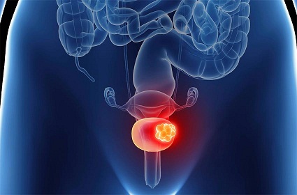 casos de cáncer